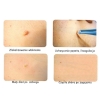 Dermatologiczna pęseta bipolarna