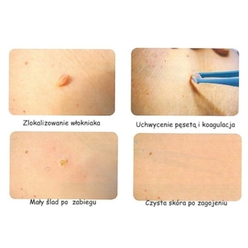 Dermatologiczna pęseta bipolarna